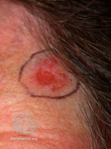 File:Basal cell carcinoma affecting the face (DermNet NZ lesions-bcc-face-0868).jpg