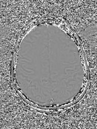 Base of skull chondrosarcoma (Radiopaedia 30410-31070 Axial SWI Phase 43).jpg