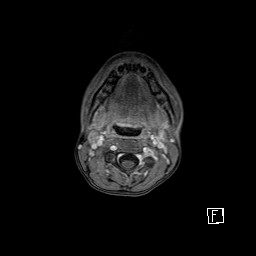 Base of skull rhabdomyosarcoma (Radiopaedia 32196-33142 T1 C+ fat sat 7).jpg