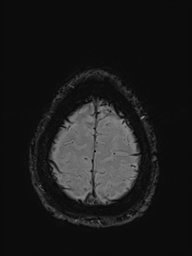 File:Basilar artery perforator aneurysm (Radiopaedia 82455-97733 Axial SWI 56).jpg