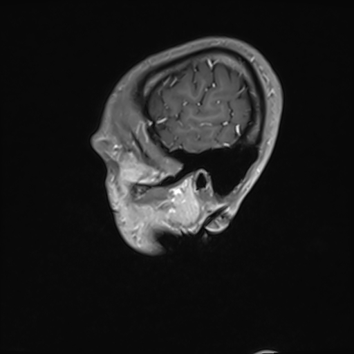 Basilar artery perforator aneurysm (Radiopaedia 82455-97733 G 18).jpg