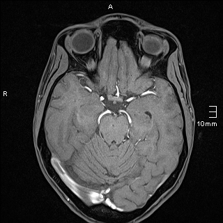 Basilar artery perforator aneurysm (Radiopaedia 82455-99523 F 52).jpg