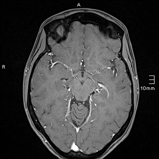 Basilar artery perforator aneurysm (Radiopaedia 82455-99523 G 62).jpg