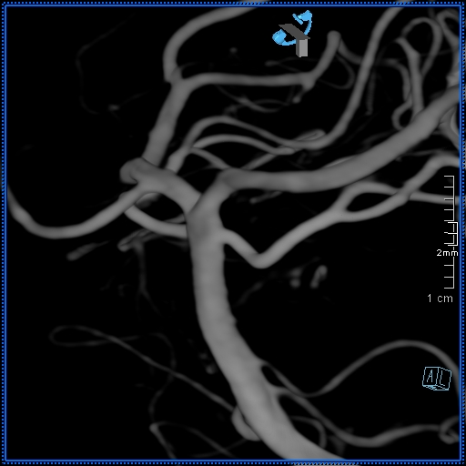 Basilar artery perforator aneurysm (Radiopaedia 82455-99524 3D Left VA 32).jpg