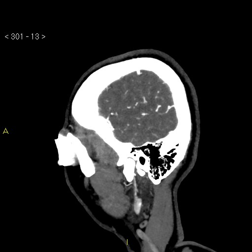 File:Basilar artery thrombosis (Radiopaedia 16260-15944 C 7).jpg