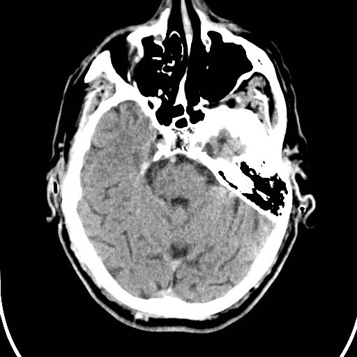 File:Basilar artery thrombosis (Radiopaedia 26986-27162 Axial non-contrast 10).jpg