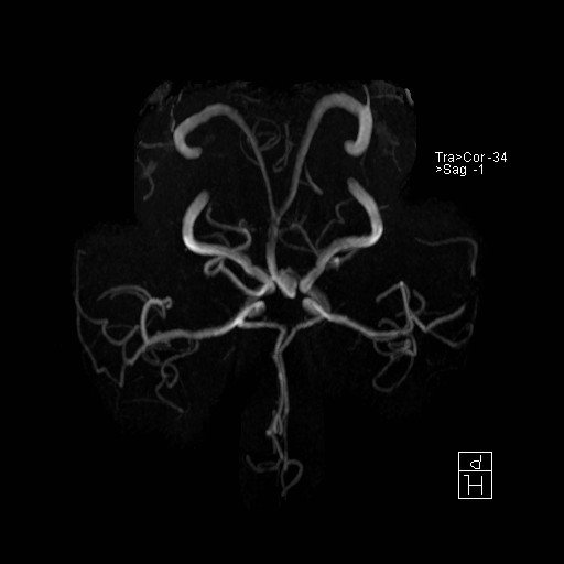 Basilar tip aneurysm (Radiopaedia 26504-26632 D 18).jpg