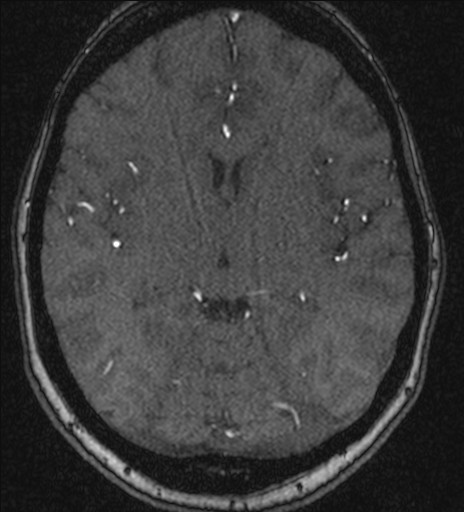 Basilar tip aneurysm (Radiopaedia 26504-26632 MRA 121).jpg