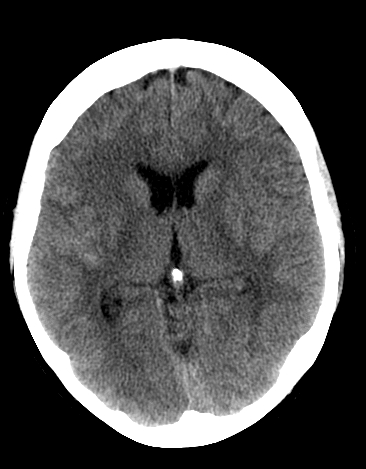 File:Basilar tip aneurysm with coiling (Radiopaedia 53912-60033 Axial non-contrast 14).jpg