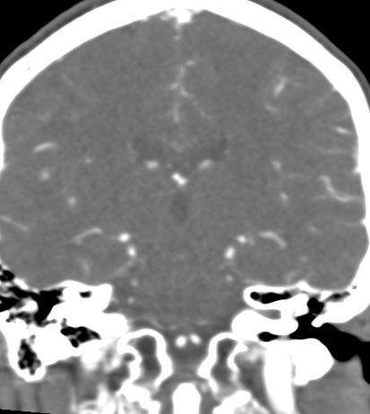 Basilar tip aneurysm with coiling (Radiopaedia 53912-60086 B 88).jpg