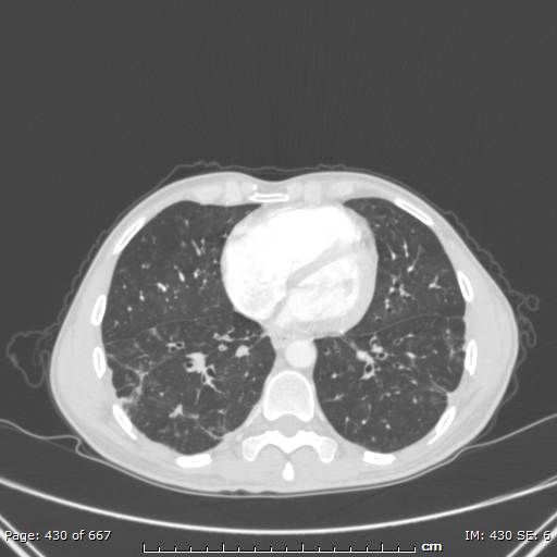 Behçet disease (Radiopaedia 44247-47889 Axial lung window 58).jpg