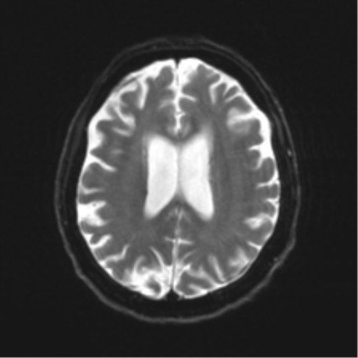 Behavioral variant frontotemporal dementia and late onset schizophrenia (Radiopaedia 52197-58083 Axial DTI Trace W 17).png