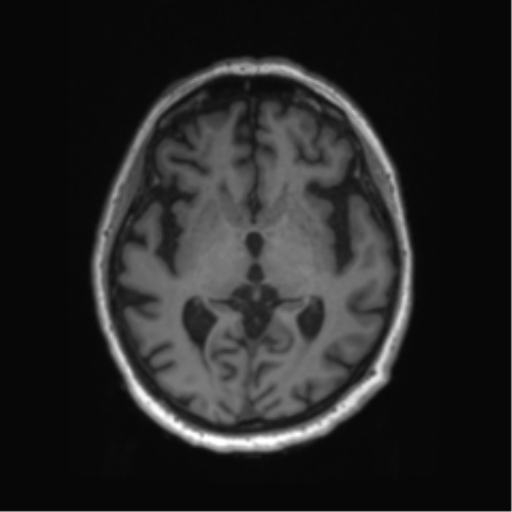 Behavioral variant frontotemporal dementia and late onset schizophrenia (Radiopaedia 52197-58083 Axial T1 54).png