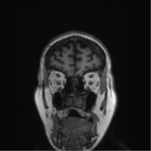 File:Behavioral variant frontotemporal dementia and late onset schizophrenia (Radiopaedia 52197-58083 Coronal T1 77).png