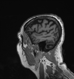 Behavioral variant frontotemporal dementia and late onset schizophrenia (Radiopaedia 52197-58083 Sagittal T1 95).png