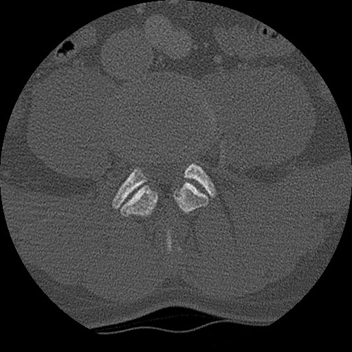 Benign post-traumatic pseudopneumoperitoneum (Radiopaedia 71199-81495 Axial bone window 248).jpg