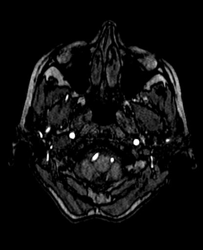 Berry aneurysm of the terminal internal carotid artery (Radiopaedia 88286-104918 Axial TOF 43).jpg