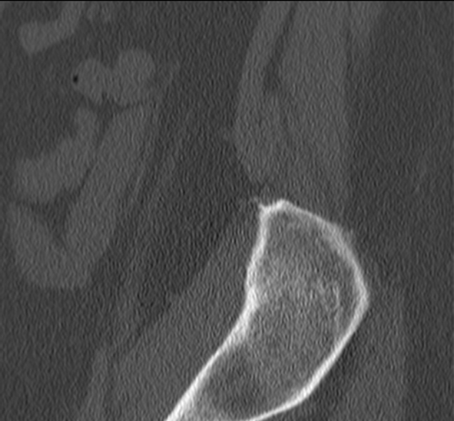 Bertolotti syndrome (Radiopaedia 24864-25128 Sagittal bone window 2).jpg