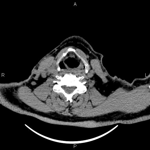 Bilateral Warthin tumors (Radiopaedia 84034-99263 Axial non-contrast 41).jpg