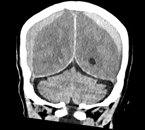 Bilateral acute on chronic subdural hematomas (Radiopaedia 78466-91146 Coronal non-contrast 50).jpg