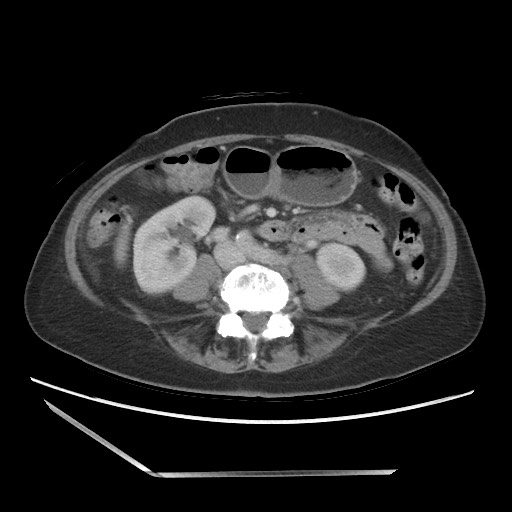 File:Bilateral adrenal granulocytic sarcomas (chloromas) (Radiopaedia 78375-91007 A 68).jpg