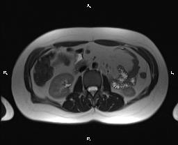 File:Bilateral adrenal myelolipoma (Radiopaedia 63058-71537 Axial T2 21).jpg
