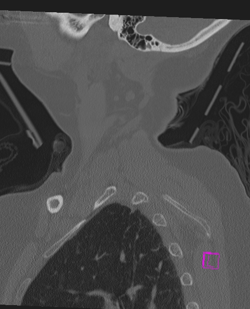 Bilateral atlanto-occipital assimilation (Radiopaedia 28350-28603 Sagittal bone window 8).jpg