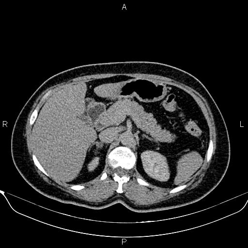 File:Bilateral benign adrenal adenomas (Radiopaedia 86912-103124 Axial C+ delayed 36).jpg