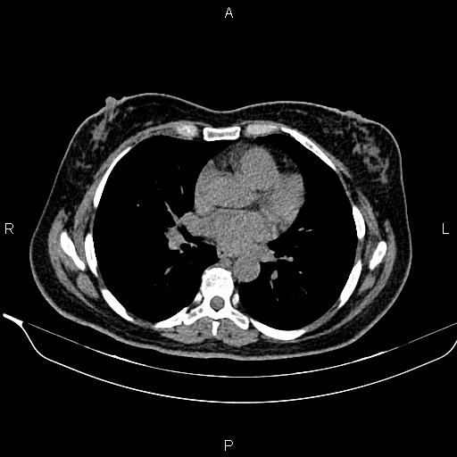 Bilateral benign adrenal adenomas (Radiopaedia 86912-103124 Axial non-contrast 3).jpg