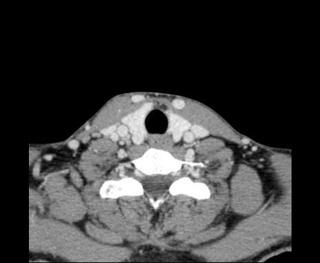 Bilateral carotid body tumors (Radiopaedia 61841-69870 Axial Post contrast 91).jpg