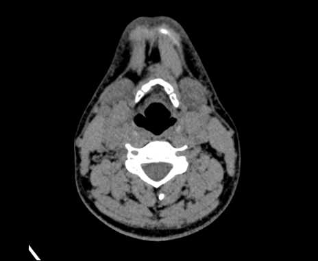 Bilateral carotid body tumors (Radiopaedia 61841-69870 Axial non-contrast 56).jpg