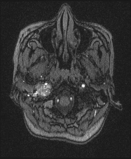 Bilateral carotid body tumors and right glomus jugulare tumor (Radiopaedia 20024-20060 Axial MRA 17).jpg