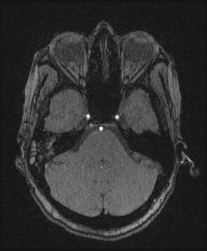 Bilateral carotid body tumors and right glomus jugulare tumor (Radiopaedia 20024-20060 Axial MRA 48).jpg