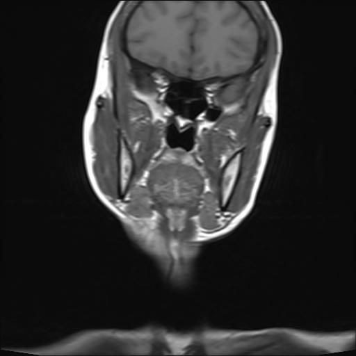 File:Bilateral carotid body tumors and right jugular paraganglioma (Radiopaedia 20024-20060 Coronal 5).jpg