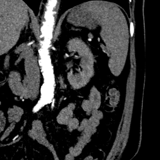 File:Bilateral delayed nephrogram from renal artery stenosis (Radiopaedia 47681-52362 B 10).png