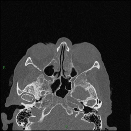 Bilateral frontal mucoceles (Radiopaedia 82352-96454 Axial bone window 159).jpg