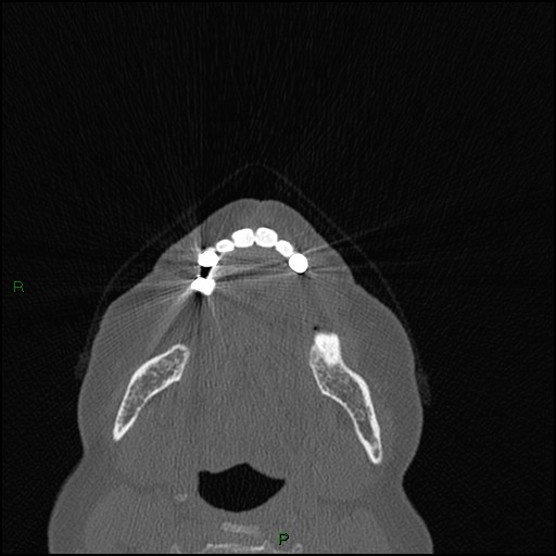 Bilateral frontal mucoceles (Radiopaedia 82352-96454 Axial bone window 290).jpg
