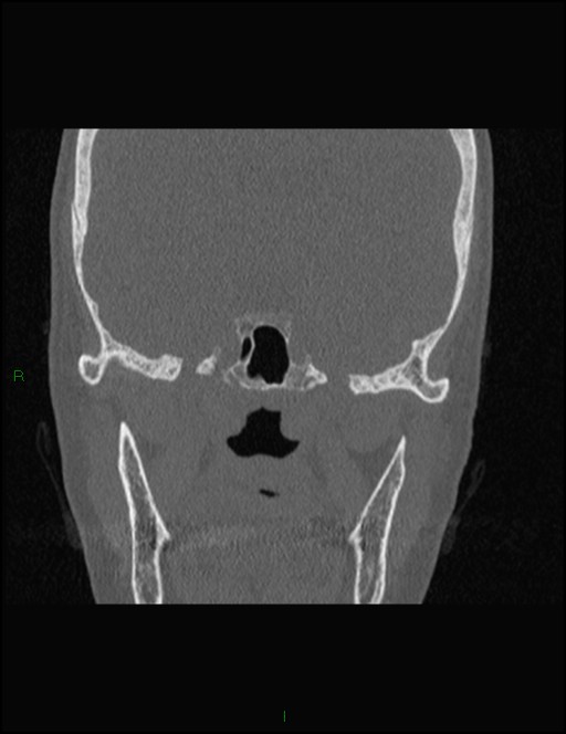 Bilateral frontal mucoceles (Radiopaedia 82352-96454 Coronal 252).jpg