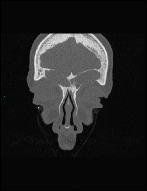 Bilateral frontal mucoceles (Radiopaedia 82352-96454 Coronal 68).jpg