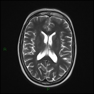 File:Bilateral frontal mucoceles (Radiopaedia 82352-96455 Axial T2 12).jpg