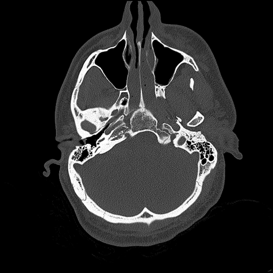 Bilateral occipital condyle fracture (type 2) (Radiopaedia 87675-104089 Axial bone thins 51).jpg