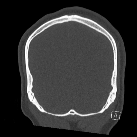 Bilateral occipital condyle fracture (type 2) (Radiopaedia 87675-104089 Coronal bone window 121).jpg