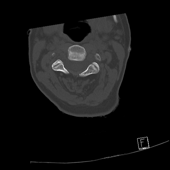 Bilateral occipital condyle fractures (type 3) (Radiopaedia 87672-104086 Axial bone window 28).jpg