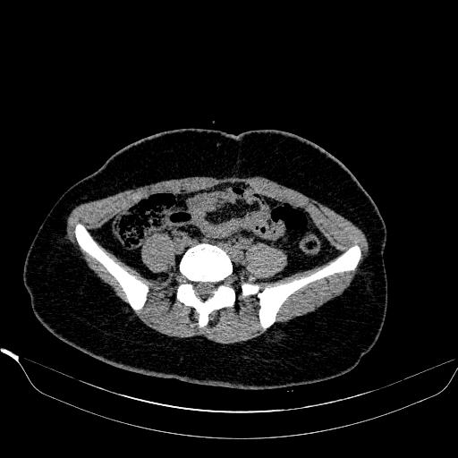File:Bilateral ovarian dermoid (Radiopaedia 45714-49907 Axial non-contrast 2).JPEG
