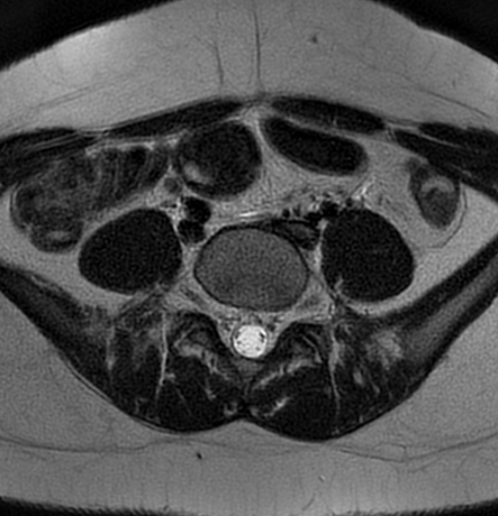 File:Bilateral ovarian fibrothecomas - adolescent (Radiopaedia 86604-102707 Axial T2 2).jpg