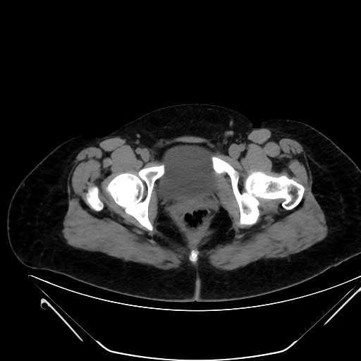 Bilateral ovarian mature cystic teratomas (Radiopaedia 79373-92457 Axial non-contrast 88).jpg