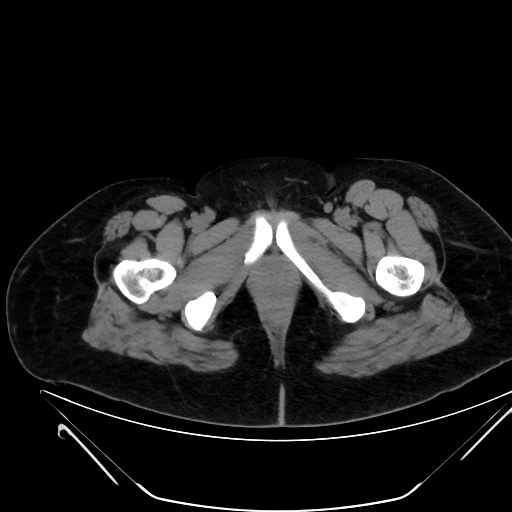Bilateral ovarian mature cystic teratomas (Radiopaedia 79373-92457 Axial non-contrast 99).jpg