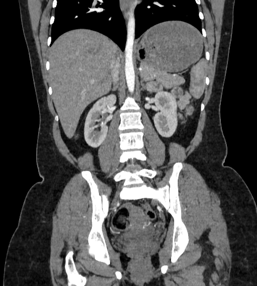 Bilateral ovarian mature cystic teratomas (Radiopaedia 79373-92457 B 51).jpg
