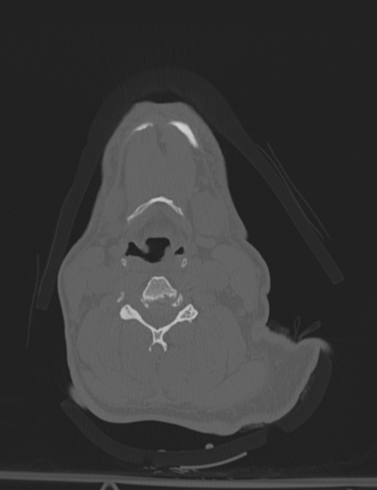 Bilateral perched facet joint (Radiopaedia 63149-71669 Axial bone window 31).jpg