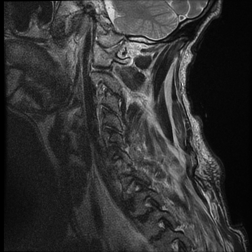 File:Bilateral perched facets with cord injury (Radiopaedia 45587-49714 Sagittal T2 2).jpg
